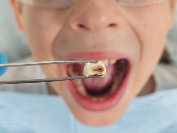 Best Root Canal Emergency Dentist  in Missouri City, TX